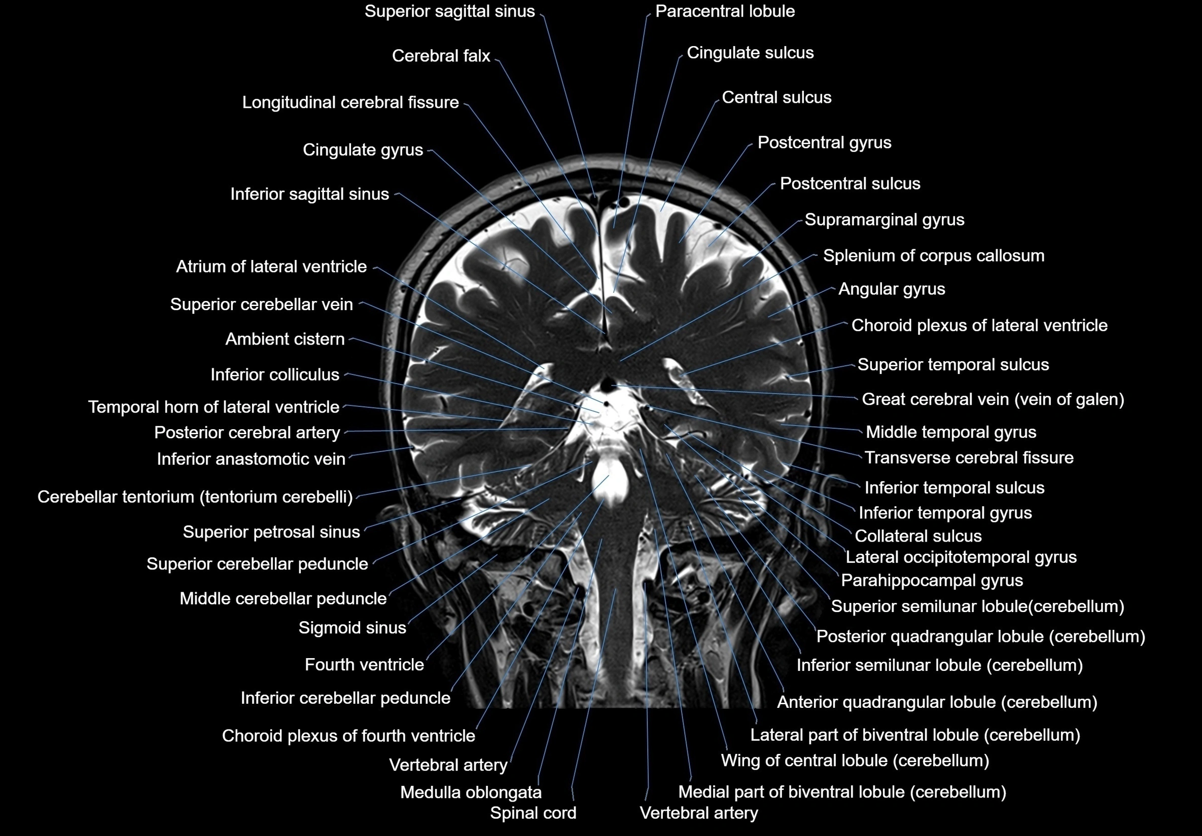 MRI Brain coronal cross sectional labelled anatomy 3T image  -img-00001-00049.webp